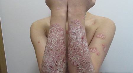 皮肤有红斑鳞屑有时候疼是不是银屑病